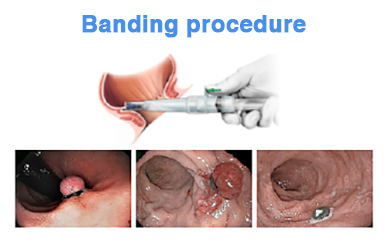 healing hydrocortisone anal fissure sanskrit male masturbation